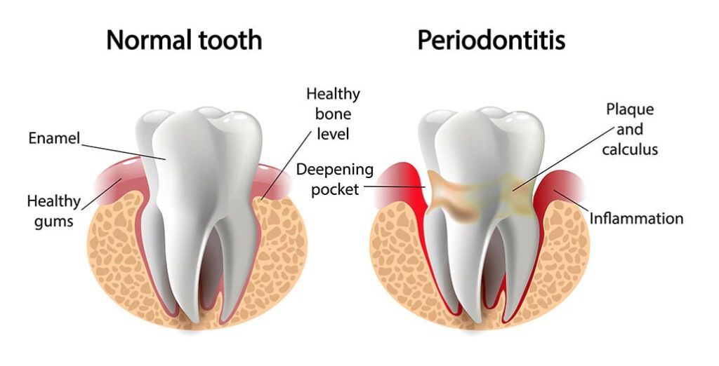 Healthy smile dental Underood periodontitis teeth decay Calamvale: trulyheal